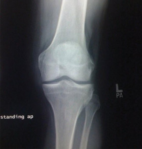 Xray of Healthy Knee