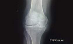 My ACL reconstructions don’t require a brace!