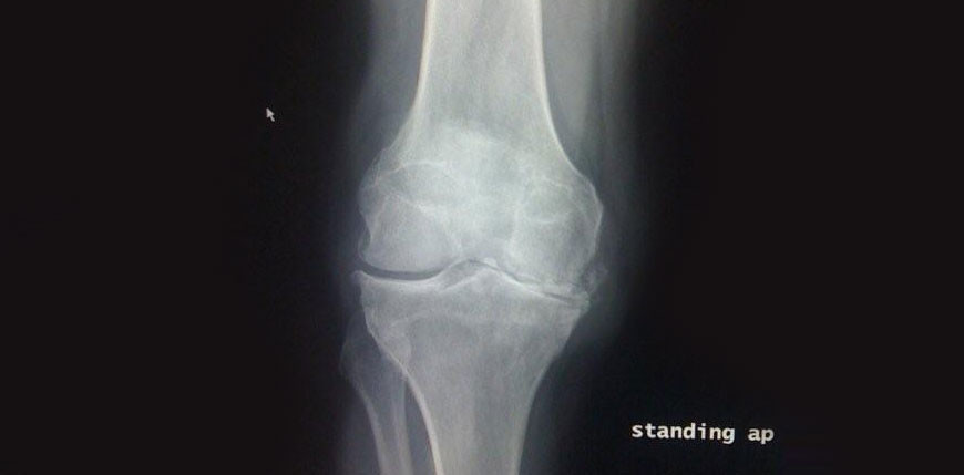 My ACL reconstructions don’t require a brace!
